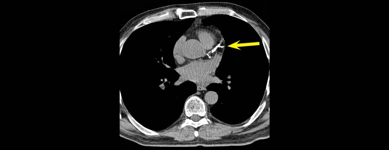 Calcium Score Test: Its Role in Preventive Health and Routine Checkups