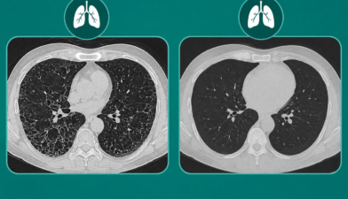 HRCT Chest vs CT Chest Scan